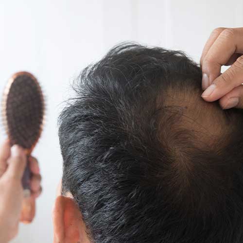 Caduta-dei-capelli